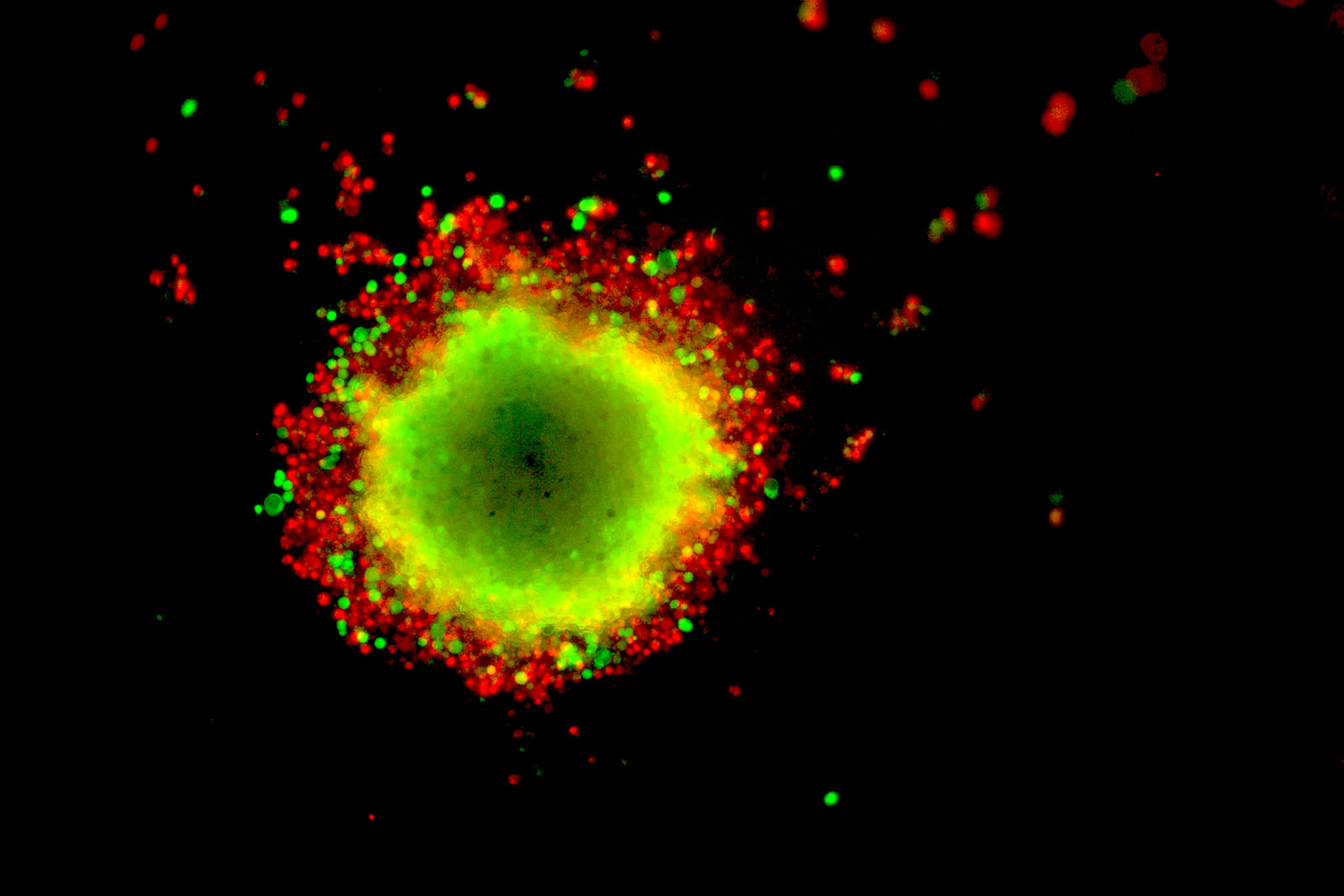 how-does-melanoma-spread-centenary-institute